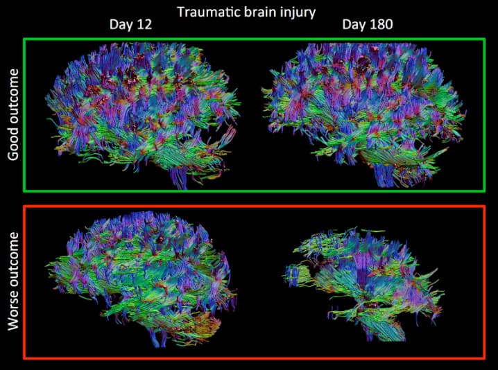 diffusion-sensor-imaging-what-is-it-exactly