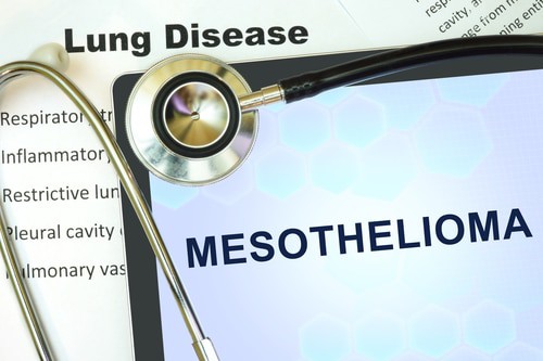 What Causes Mesothelioma Lung Cancer?